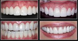 veneers-before-and-after1